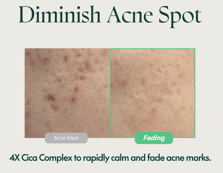 PURITO Wonder Releaf Centella Serum - helps diminish acne spots
